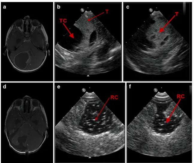 Fig. 2 Illustrative case no. 2 (case 19, H.N.): preoperative axial T1 MRI with contrast (a) of a 4-year-old male patient with a pilocytic astrocytoma in the right cerebellum and the corresponding  intra-operative RT-3-D IOUS images (b, c) in “X-Plane” mode