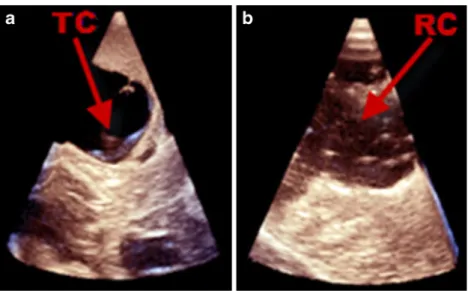 Fig. 4 Illustrative case no. 3 (case 14, M.E.): preoperative axial T1 MRI with contrast (a) of a 9-year-old female with a medulloblastoma in the fourth ventricle and the corresponding “ X-Plane ” 3-D IOUS images in “ X-Plane ” mode as shown in coronal (b) 