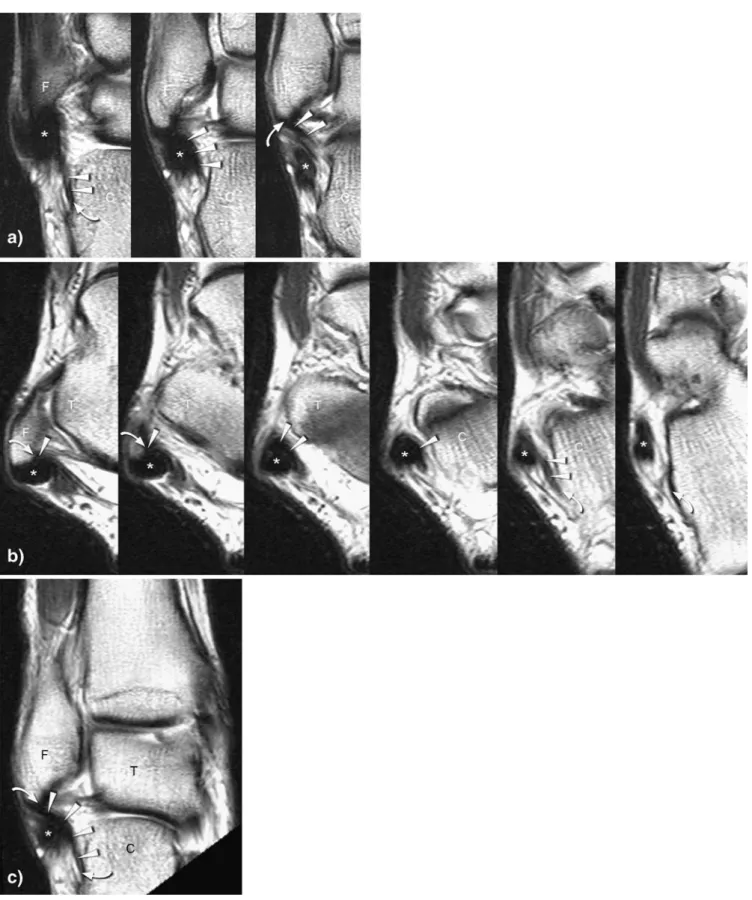 Fig. 3 Visualization of the calcaneofibular ligament on coronal and axial 2D TSE and on MPR