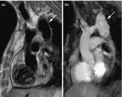 Figure 12. Oblique sagittal spin-echo (a) and cine-MIP image (b) after coarctation repair demonstrate a huge pseudoaneurysm (arrows) at the level of the previous isthmic coarctation.