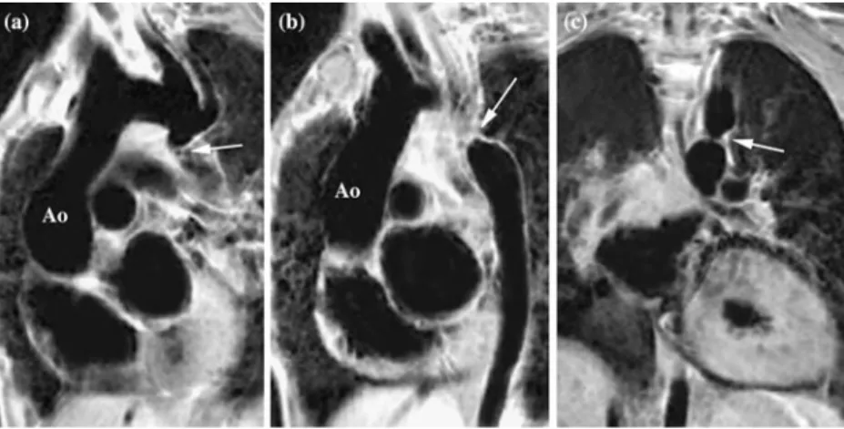 Figure 2. Example of a tortuous course of the aortic arch. Despite a supposed good alignment with the aortic arch, the narrowing cannot be demonstrated on a single oblique sagittal plane (a, b) and only the coronal plane encompassing the origin of the desc