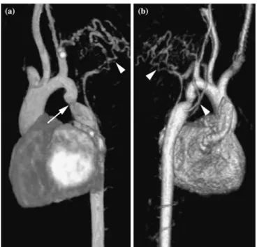 Figure 6. Oblique thick-slab MPR (a) and volume rendering (b) reconstructions of a Gadolinium-enhanced MR angiography are the best techniques to image the entire thoracic aorta and to display the aortic coarctation (arrow)