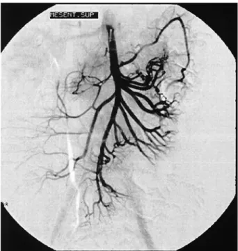 Fig. 1. Superior mesenteric arteriography shows no sign of contrast extravasation.