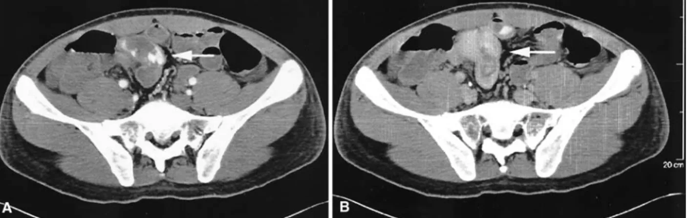 Fig. 3. Overview of the resection tissue. Inside the MD lumen, the wider mucosa folds up