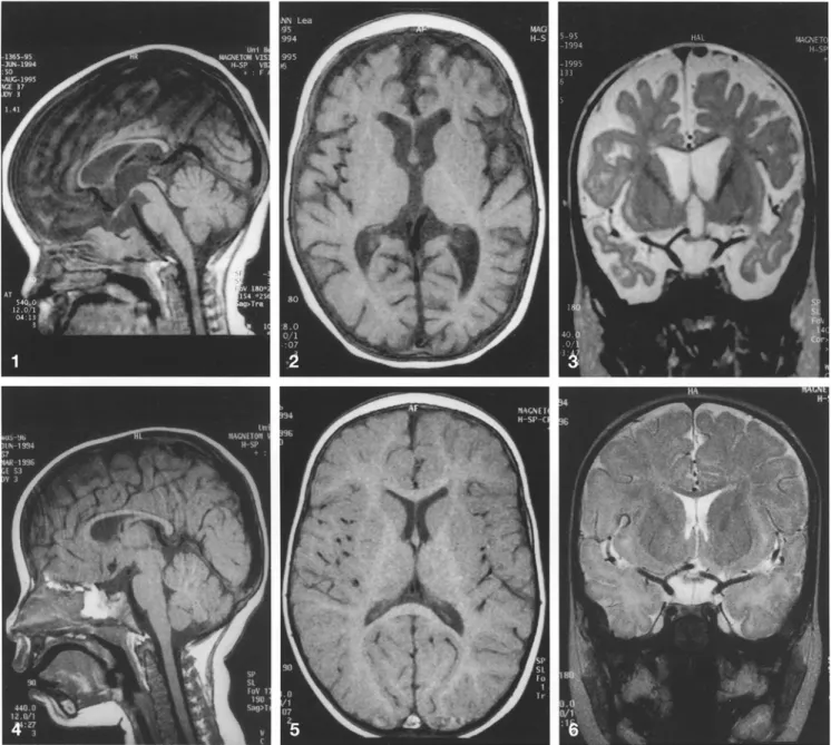 Fig.  3 Coronal T2-weighted section showing markedly wide cere- cere-bral sulci and ventricles
