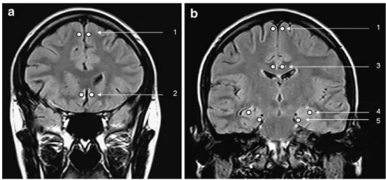 Fig. 1 Coronal FLAIR MR images. a First slice showing circles at the locations of the ROIs in the frontal isocortex (1) and subcallosal area cortex (2).
