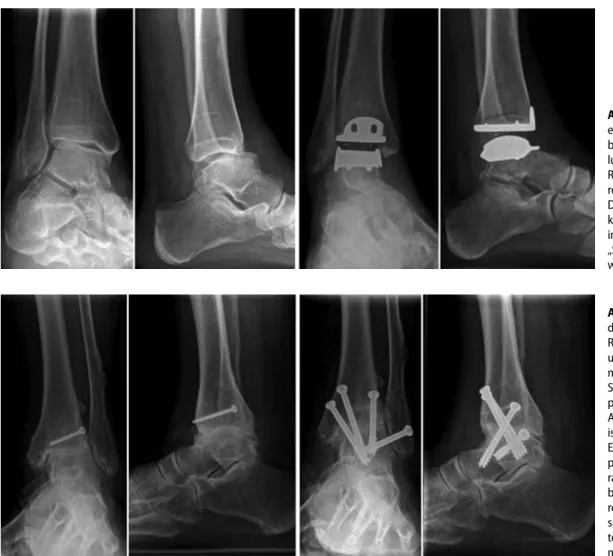 Abb. 2  9  Abgebildet sind  die a.-p.- und seitlichen  Röntgenbilder präoperativ   und 6 Wochen nach mini-mal-invasiv durchgeführter  Schraubenarthrodese bei  posttraumatischer OSG-  Arthrose. Gut zu erkennen   ist die Stellungskorrektur.   Es zeigt sich 6
