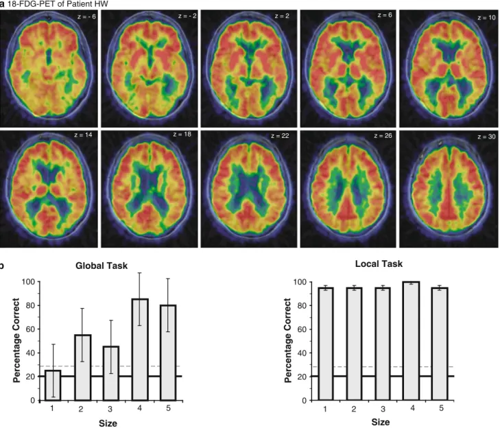Fig. 1 a 18-Fluorodeoxyglucose positron emission tomography (FDG-PET) scans overlaid with the magnetic resonance imaging (MRI) scans revealed reduced metabolism in the parieto-occipital cortex bilaterally for patient HW
