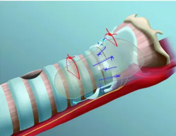 Fig. 4 Endoscopic removal of the LT-Mold TM . The larynx is exposed with a Lindholm laryngoscope, and the head of the prosthesis is uncapped with curved microscissors