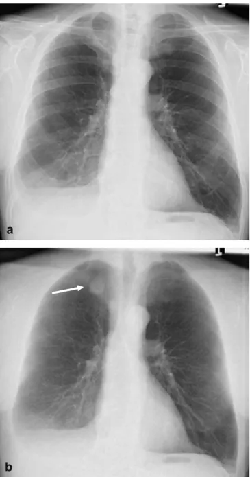 Table 1 Summary of diagnoses in 77 study patients and size ranges of the 200 pulmonary lesions detected in chest CT