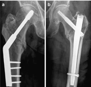 Fig. 2 Implants for the blade group. a Dynamic hip system (DHS) blade. b Proximal femoral nail antirotation (PFNA)