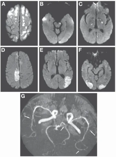 Fig. 1.     Axial diffusion-weighted MRI shows multiple lesions in the superior part of the frontal and parietal lobes   (A)  in the midbrain   (B)   and in the basal ganglion areas   (C) 