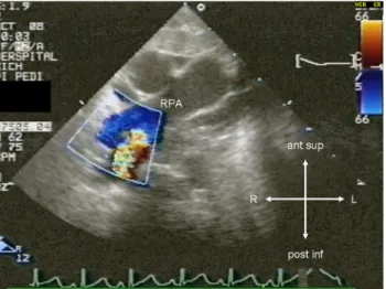 Fig. 1 Preinterventional transthoracic echocardiography. The modi- modi-fied high parasternal short-axis view shows the right pulmonary artery (RPA)