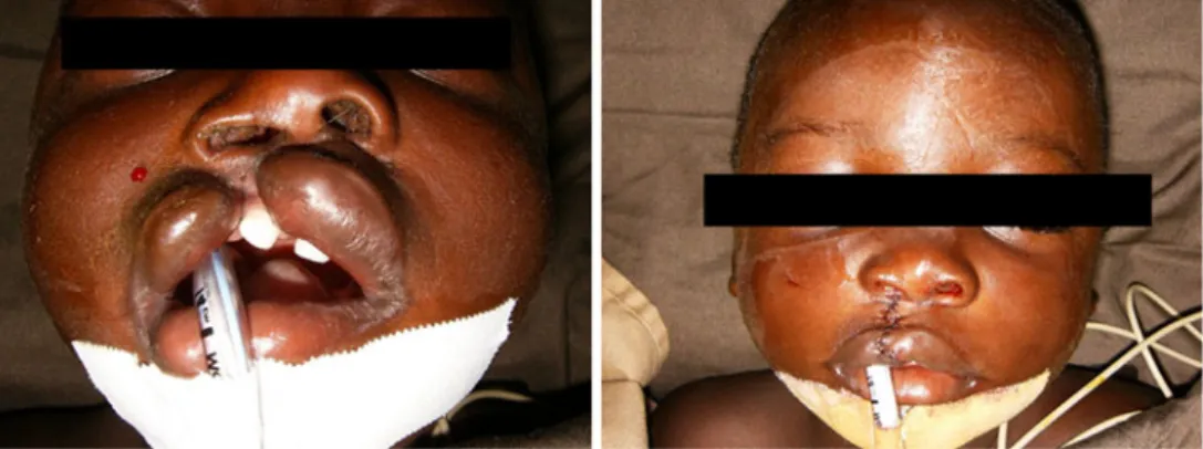 Fig. 2 Example of unilateral cleft lip and palate (UCLP) before and after surgery