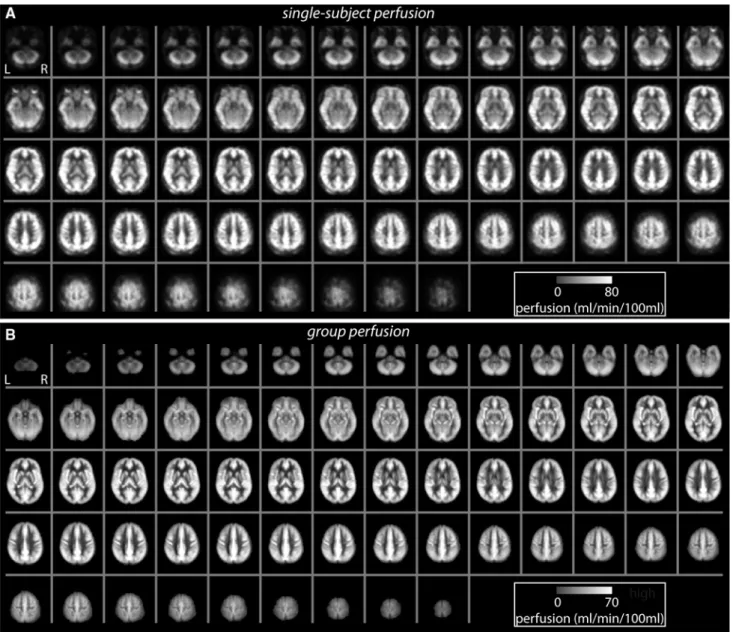 Fig. 4 Resting whole-brain perfusion. a Results for a single-subject and, b a group perfusion map generated from the average perfusion across all subjects