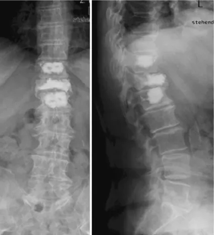 Fig. 9 A 70-year-old female patient: lordoplasty performed on a vertebral compression fracture of T12:
