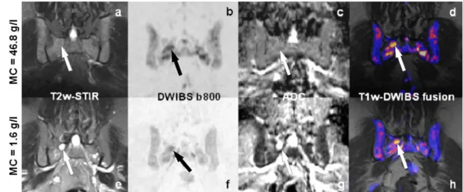 Figure 5 shows signal alterations in a 48 year-old man who presented at initial diagnosis (Fig