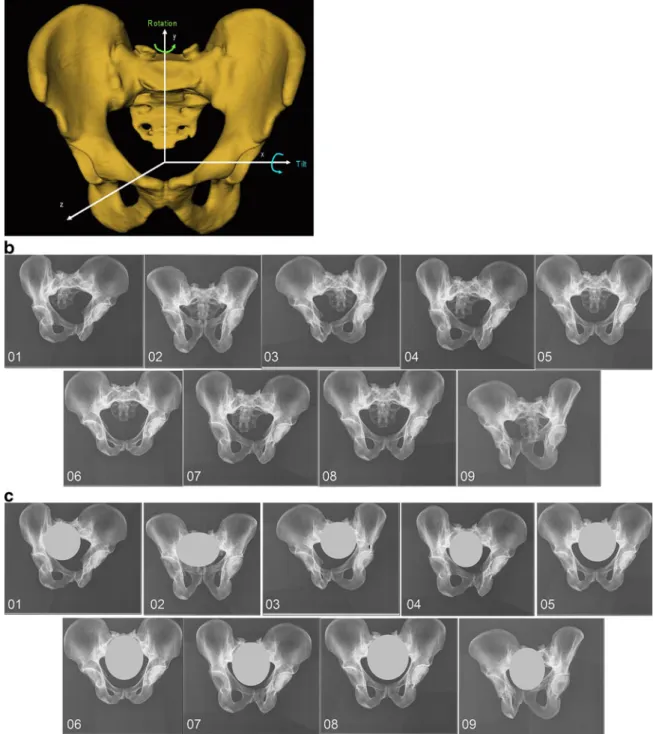 Fig 5. a Definitions of the tilt and the rotation of the pelvis relative to the X-ray plate