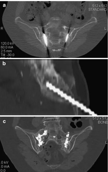 Fig. 4 CT of a 76-year-old female patient with bilateral sacral fractures successfully treated with long-axis sacroplasty (a and b) shows adequate and homogeneous cement distribution on both sides (c)
