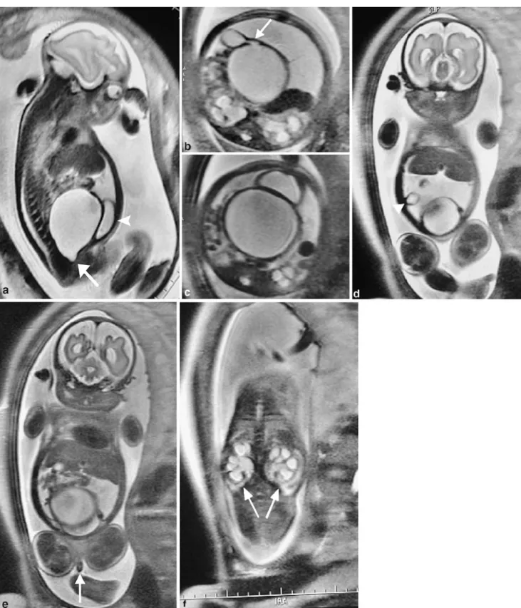 Fig. 1 Fetal MRI. a Sagittal T2-W image shows a distended fluid- fluid-filled ‘cyst’ with a beak-like lower margin pointing into the pelvis ( arrow )