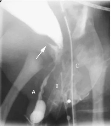 Fig. 5 Retrograde study with simultaneous injection through one catheter through the duplicated phallic urethra ( A ), one into the urogenital sinus ( B ) and one into the rectum ( C )