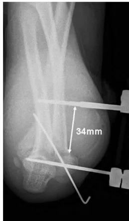 Table 2 Patients, fracture types and treatments