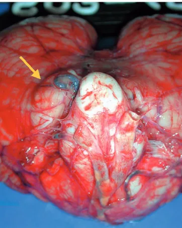 Fig. 6 Predominant swelling of the left cerebellar tonsil in case 1 in autopsy (arrow)