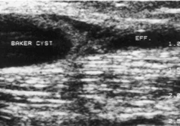 Fig. 1 Arthrography showing ﬁlling of a deep and a superﬁcial portion of a popliteal cyst
