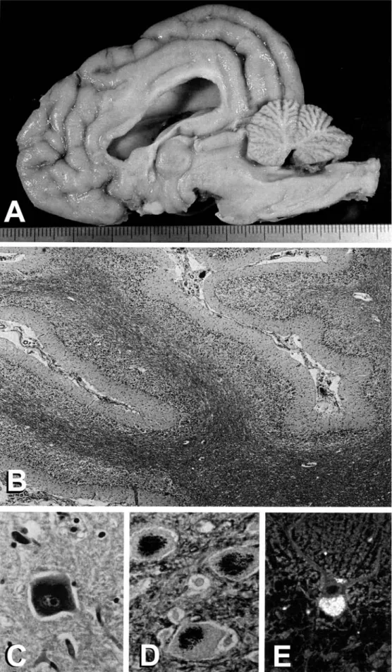 Fig. 1 A Gross pathology of case 8, showing marked cerebellar atrophy. B
