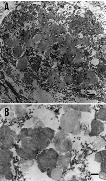 Fig. 4 Electron microscopy. A Ballooned neurons from the lateral geniculate body in case 1