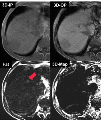 Fig. 4 Axial 3D IP/OP images with automatic reconstruction of fat- fat-only images and corresponding 3D IP/OP fat fraction maps of a  56-year-old patient suffering from liver cirrhosis (Child B) with  biopsy-proven moderate-to-severe iron overload of liver