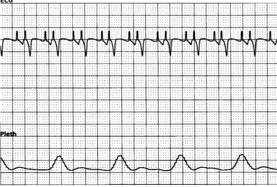 Fig. 1 Electrocardiogram and plethysmographic wave (Pleth) of case 1. The patient’s heart rate is 129/min on the ECG tracing (atrio-ventricular pacing), while the completely dissociated pulse generated by the mechanical assist device is seen at 60/min