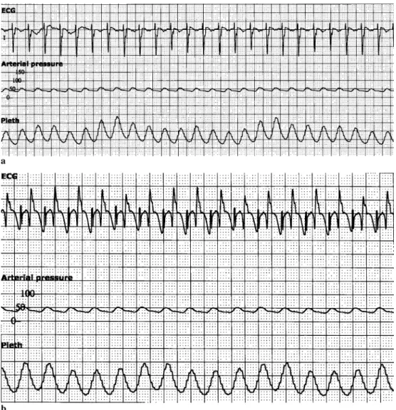 Fig. 2 Electrocardiogram, invasive arterial pressure and plethysmographic wave (Pleth) of case 2