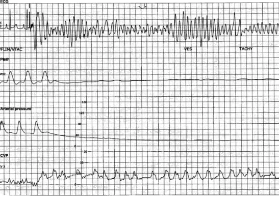 Fig. 3 Electrocardiogram, plethysmographic wave (Pleth), invasive arterial pressure and central venous pressure (CVP) of case 3