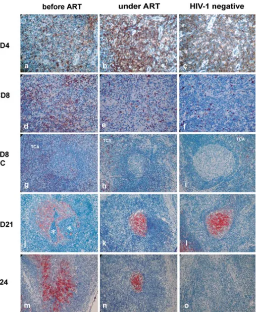 Figure 2. Immunohistochemical localization of CD4 (brown DAB reaction product), CD8, CD21, and p24 (red AEC reaction product) in a lymph node of a patient before and after antiretroviral therapy (ART) and in a lymph node of a  HIV-negative individual