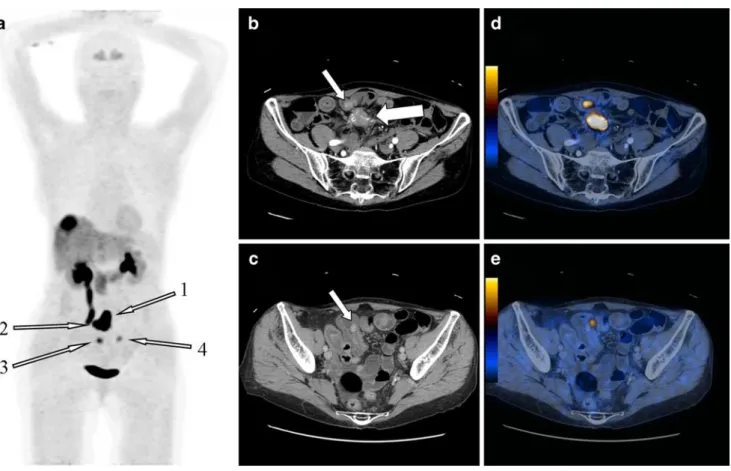 Fig. 1 a MIP, b and d axial contrast-enhanced CT, c and e combined DOPA-cePET/CT. Seventy-five-year-old woman with known liver metastases of a well-differentiated neuroendocrine carcinoma