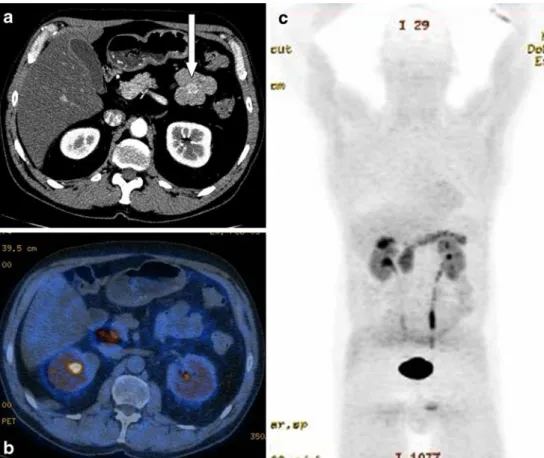 Fig. 3 a contrast-enhanced (arterial phase) axial CT, b corresponding DOPA-PET/CT, c corresponding MIP image.
