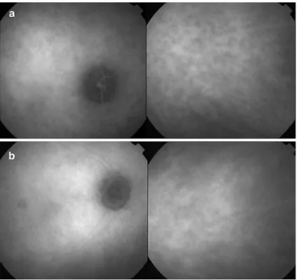 Fig. 2 (a) Hypofluorescent dark dots erased at the late angiographic phase (partial thickness choroidal lesions)