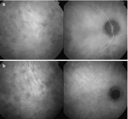 Fig. 3 (a) Hypofluorescent dark dots remaining up to the late angiographic phase (full thickness choroidal lesions)