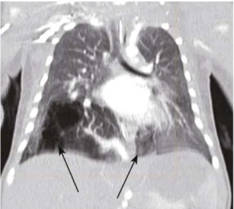 Fig. 1. Doppler ultrasonography with echogenic mass (EM) in the fetal  thorax at 20 weeks of gestation.