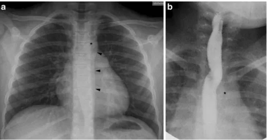 Fig. 4 a, b Vascular ring caused by a right aortic arch with mirror- mirror-image branching and left ductus ligament in a 9-month-old boy with stridor since birth