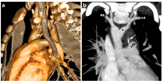Fig. 6 a, b Right circumflex aortic arch in an 8-year-old girl with recurrent respiratory  infec-tions