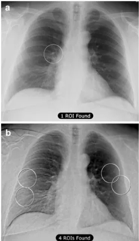 Table 4 Causes for FP findings with the CAD software on chest radiographs without and with ES ( NA not applicable)