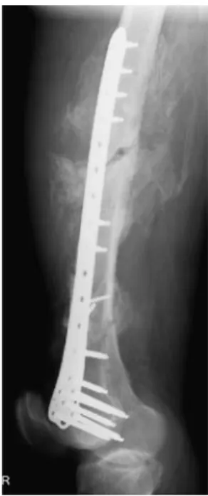 Fig. 1 Heterotopic ossification (HO) in a 42-year-old male following femoral shaft fracture and plate osteosynthesis