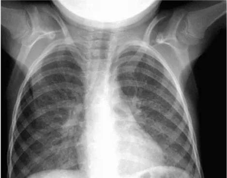 Fig. 1 Chest X-ray ﬁlm demonstrating a