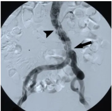 Fig. 2. Angulated reformatted CT image: Multiple polypoid, centrally dissociated (arrowhead) and distally confluent (arrow) mural alterations.