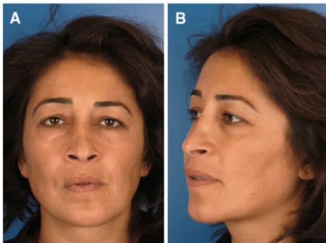 Fig. 10 Documentation 12 months after surgery. a Frontal and b left oblique views showing a satisfactory cosmetic and dimensional reconstruction