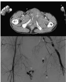 Fig. 5 Pelvic fracture in an 85-year-old man. On the left side of the patient, the extravasation of contrast medium from the spongy bone is visible due to the delayed phase from the first injection (black arrows, left image)