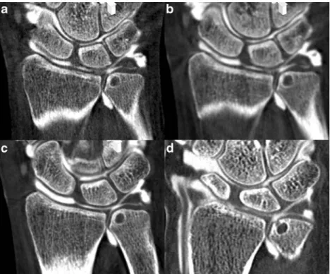 Fig. 2 Coronal reformations of human cadaveric wrist arthrographies acquired with intra-articular contrast material at an iodine concentration of 45 mg/ml with FPCT a 5-s, b 8 s, c 20-s runs and d MDCT.