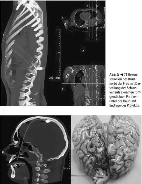 Abb. 4   8  CT-Rekonstruktion des Schädels des Mannes mit Darstellung des Projektilverlaufes (links) im  Vergleich zum Sektionsbefund des Gehirns mit Fadenmarkierung des Projektilverlaufs (rechts)